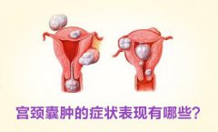 宫颈囊肿是怎么回事