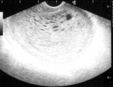 妇科检查可以不要阴式B超吗