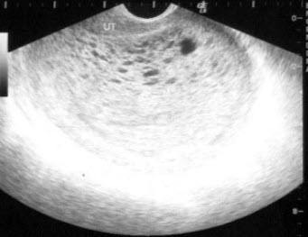 妇科检查可以不要阴式B超吗 